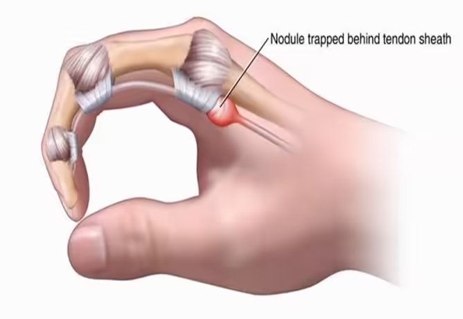 Mô hình ngón tay lò xo với nốt gân bị kẹt dưới bao gân