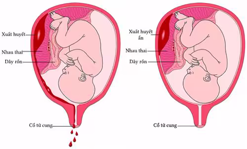 Sơ đồ nhau bong non với vùng chảy máu giữa bánh nhau và thành tử cung