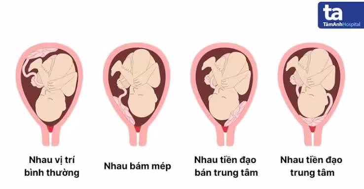 Sơ đồ các vị trí bánh nhau trong nhau tiền đạo