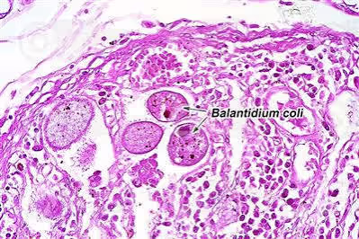 Hình hiển vi mô phỏng ký sinh trùng Balantidium coli trong mô ruột