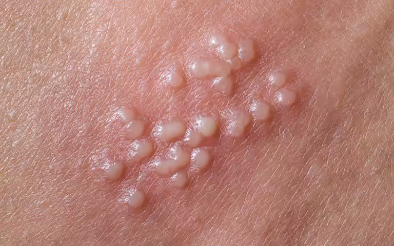 Cụm mụn nước đau rát trên da, biểu hiện thường gặp của Herpes simplex