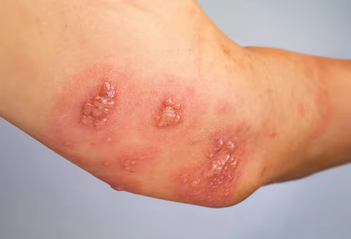 Cụm mụn nước thành dải trên cánh tay, biểu hiện điển hình của zona thần kinh