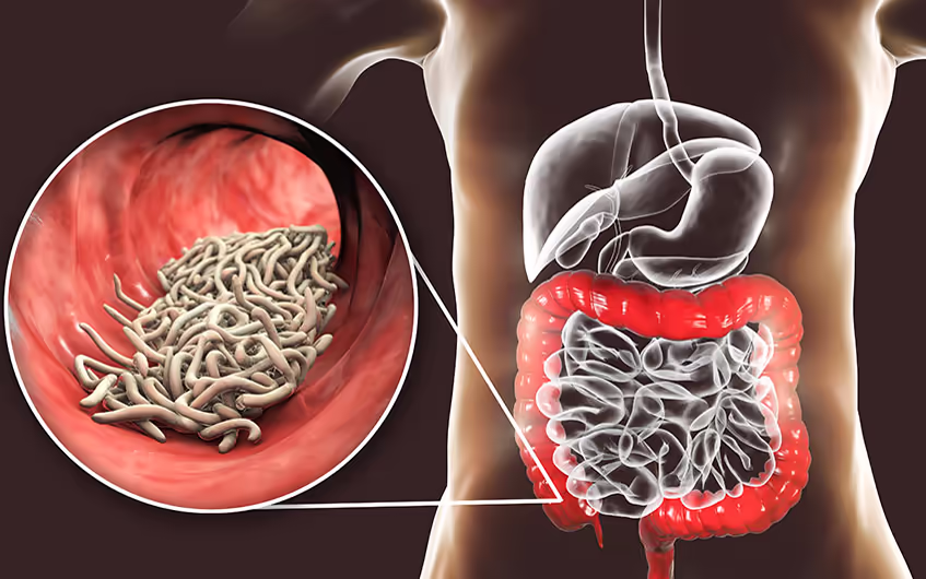 Minh họa ký sinh trùng trong đường ruột