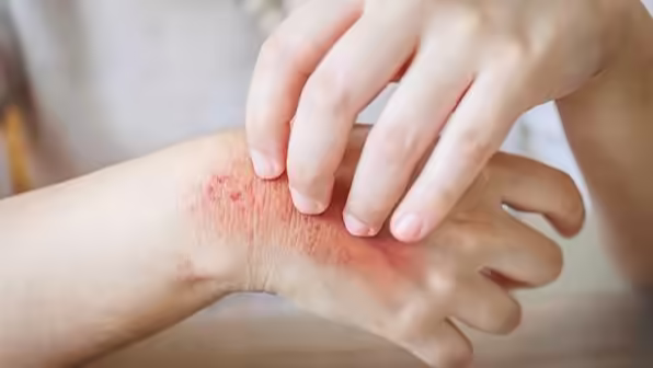 Vùng da đỏ ngứa được người bệnh gãi, biểu hiện có thể gặp khi nhiễm nấm