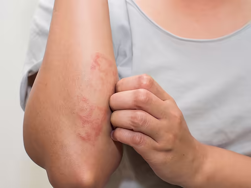Vùng da cẳng tay đỏ ngứa sau tiếp xúc nguồn nước có nguy cơ sán máng