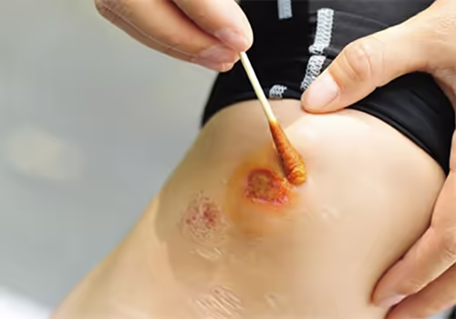 Vết thương đỏ sưng được lấy mẫu dịch để đánh giá nhiễm trùng