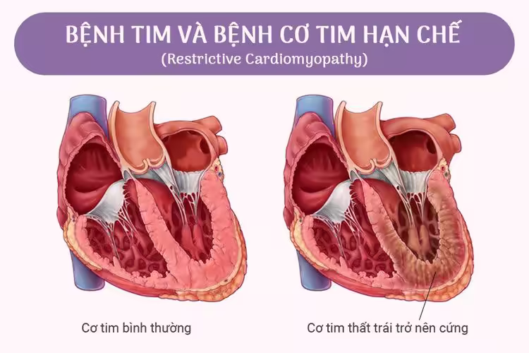 So sánh cơ tim bình thường và cơ tim thất trái trở nên cứng
