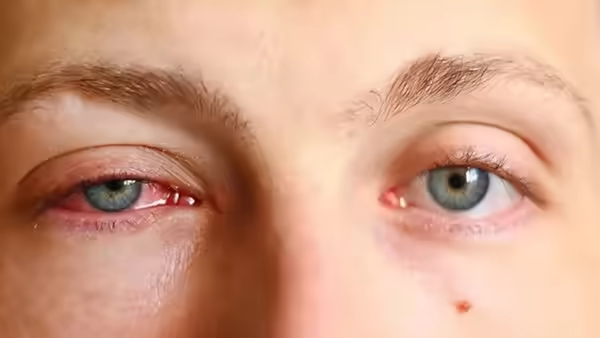 Mắt đỏ kích ứng, dấu hiệu cần khám khi có đau hoặc nhìn mờ