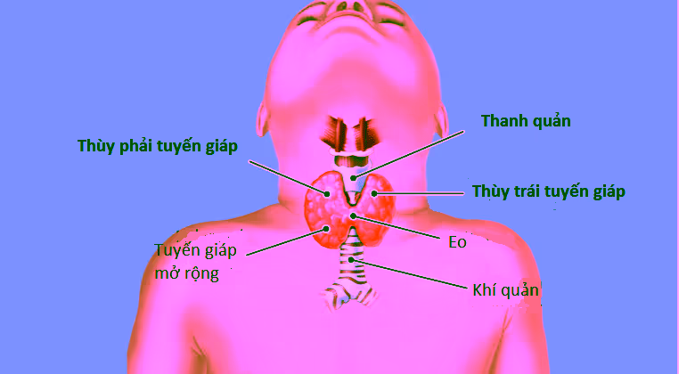 Hình minh họa tuyến giáp phì đại ở người bệnh cường giáp