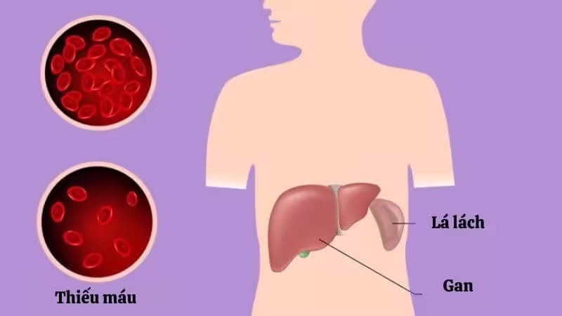 Minh họa lá lách to và tình trạng thiếu máu trong cường lách