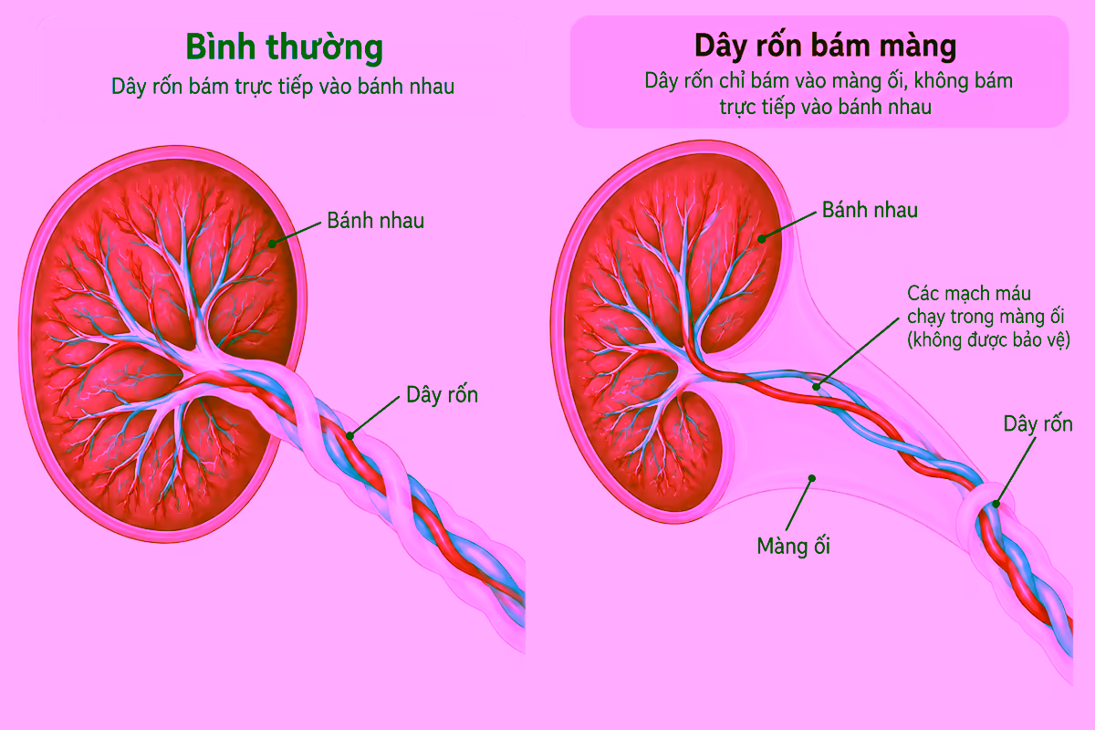 Sơ đồ so sánh dây rốn bám bình thường và dây rốn bám màng