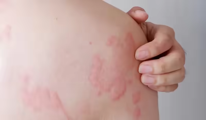Các mảng da đỏ ngứa và nổi mề đay trong phản ứng dị ứng