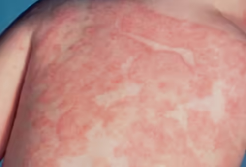 Mảng da đỏ loang lổ trong phản ứng dị ứng da