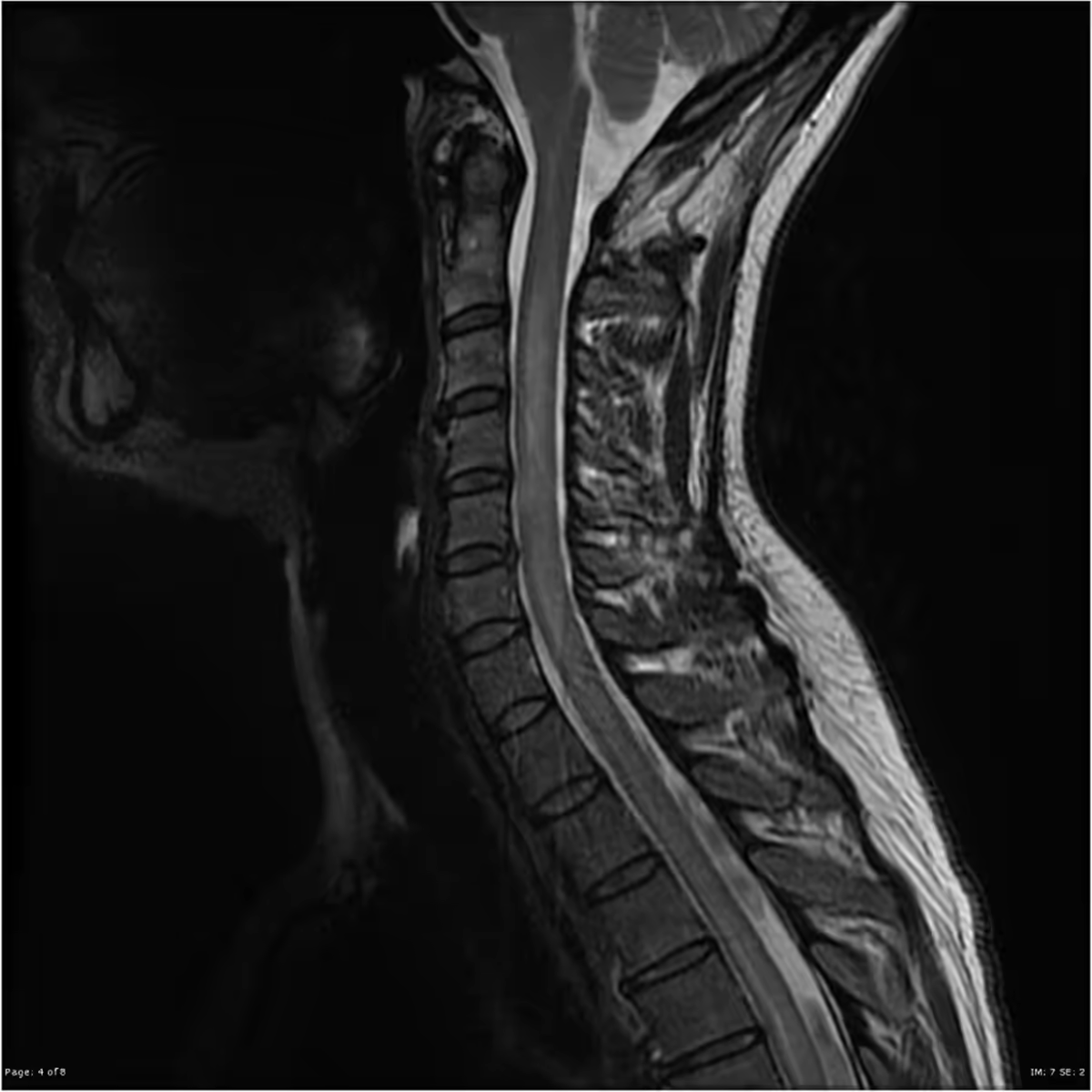 Ảnh MRI cột sống cổ trong đánh giá viêm tủy thị thần kinh