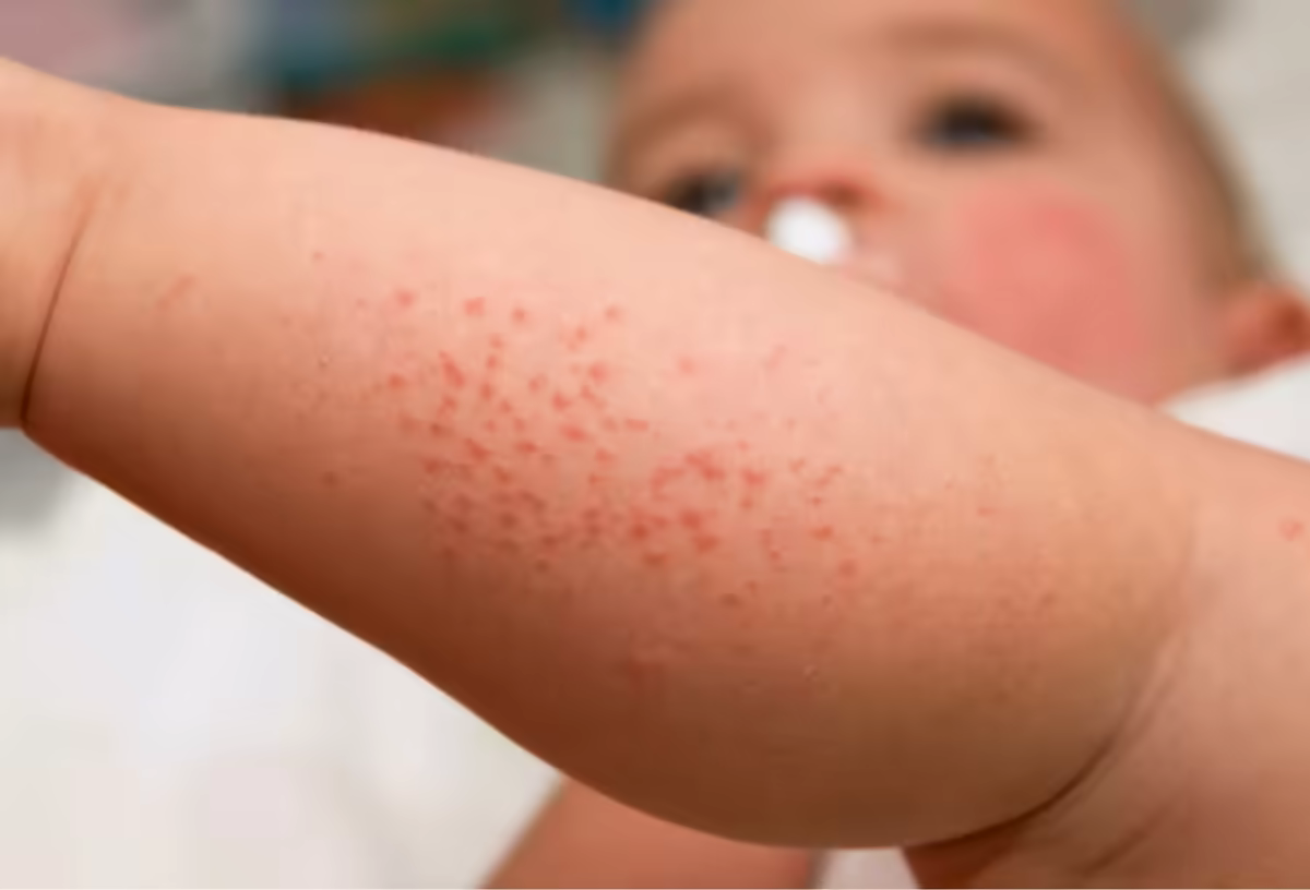 Các nốt rôm đỏ li ti trên cánh tay trẻ nhỏ
