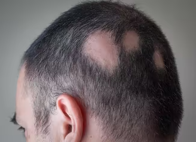 Các mảng tóc rụng thành đám trên da đầu