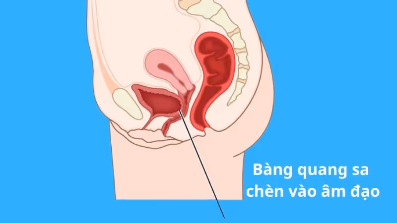 Sơ đồ bàng quang sa chèn vào âm đạo ở phụ nữ