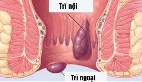 Sơ đồ búi trĩ nội và trĩ ngoại sa ra ngoài hậu môn