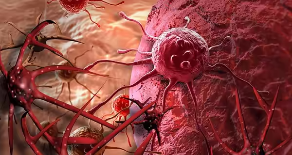 Minh họa tế bào sarcoma mạch máu phát triển bất thường trong mô