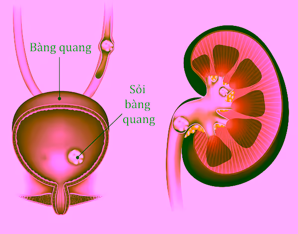 Sơ đồ sỏi trong bàng quang và hệ tiết niệu