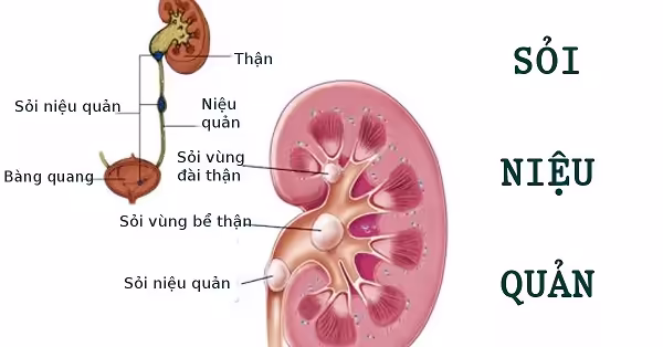 Sơ đồ sỏi từ thận di chuyển xuống niệu quản và bàng quang