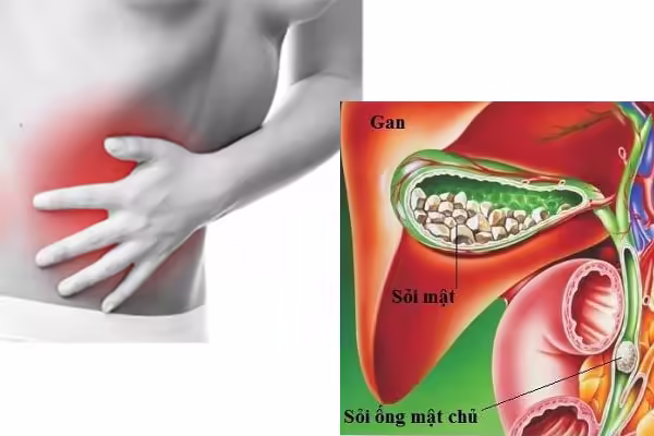 Minh họa sỏi trong túi mật và ống mật chủ gây đau bụng