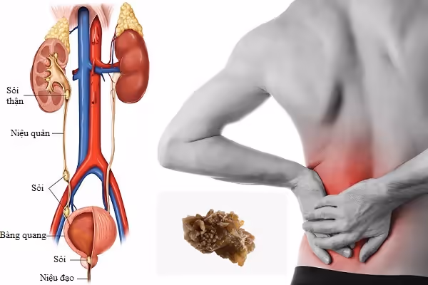 Người bệnh đau hông lưng bên cạnh sơ đồ sỏi trong đường tiết niệu