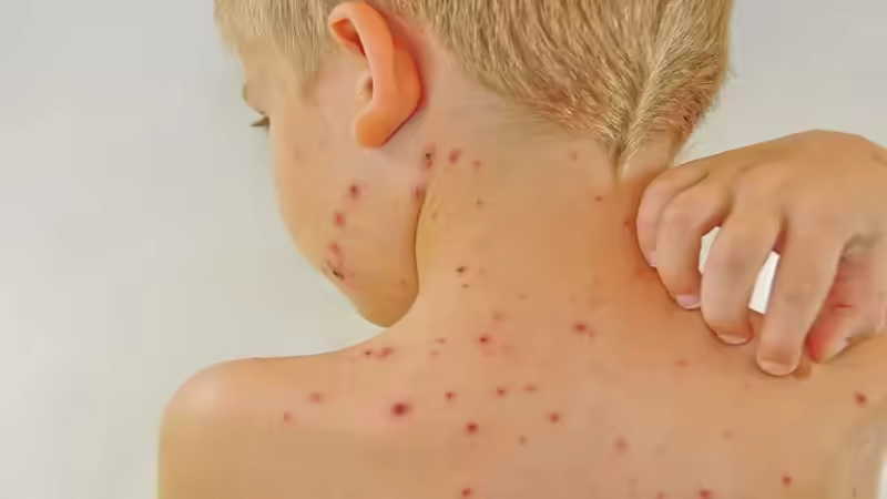 Trẻ sốt siêu vi nổi các nốt phát ban và ngứa trên da
