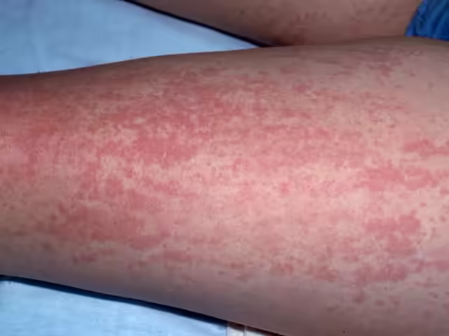 Ban da cam hồng dạng dát trên da trong bệnh Still ở người lớn