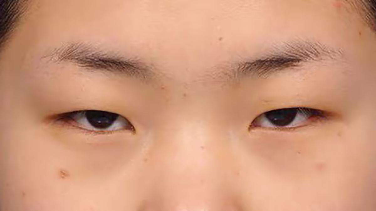 Hai mí mắt sụp xuống, biểu hiện của tình trạng sụp mi