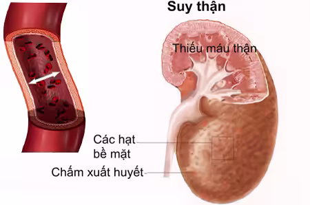 Hình minh họa tổn thương và thiếu máu ở thận