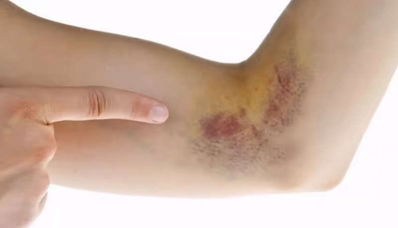 Vết bầm tím trên tay, dấu hiệu có thể gặp khi suy tủy xương