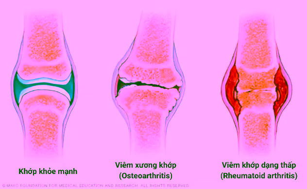 Hình minh họa khớp sưng viêm so với khớp khỏe mạnh