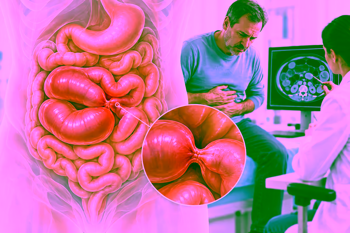 Ruột non giãn và bị tắc, kèm bệnh nhân đau bụng được bác sĩ thăm khám