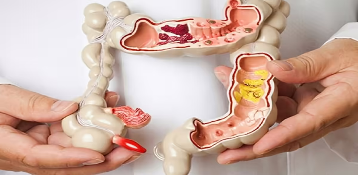 Mô hình đại tràng minh họa vị trí tắc ruột già