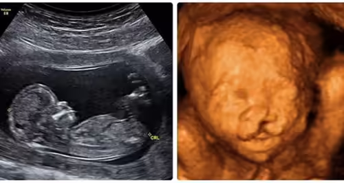 Siêu âm thai minh họa dị tật vùng hàm mặt