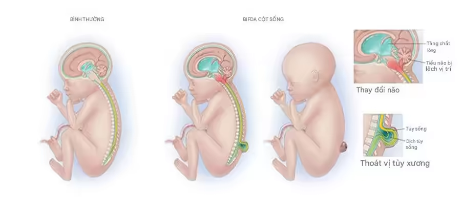 So sánh thai nhi bình thường và tật nứt đốt sống