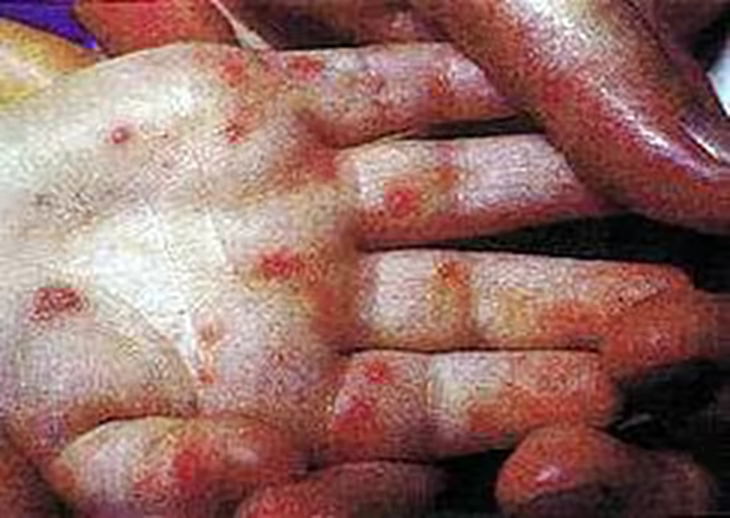 Các nốt phỏng và ban đỏ trên bàn tay do virus Coxsackie