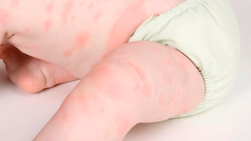 Mẩn đỏ kích ứng xuất hiện trên da trẻ em do tác động của dị nguyên thời tiết