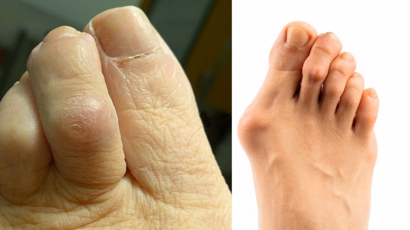 Hình ảnh minh họa vị trí khớp ngón chân cái bị tổn thương sưng u do nhiều nguyên nhân
