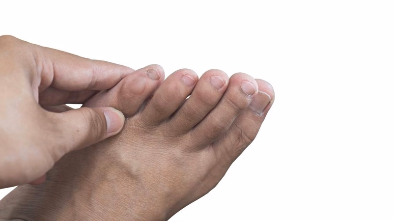 Hình ảnh mô phỏng u bướu sưng bất thường xuất hiện ở khu vực ngón chân
