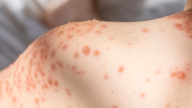 Hướng dẫn chăm sóc và giữ vệ sinh da cho trẻ em giúp ngăn ngừa u mềm lây