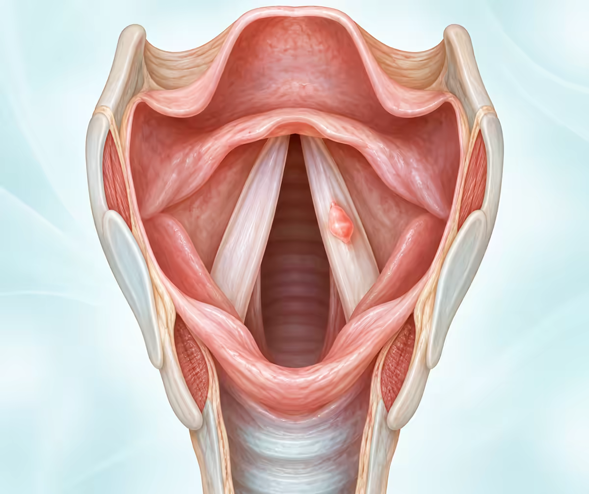 Minh họa khối u nhỏ trên một dây thanh quản