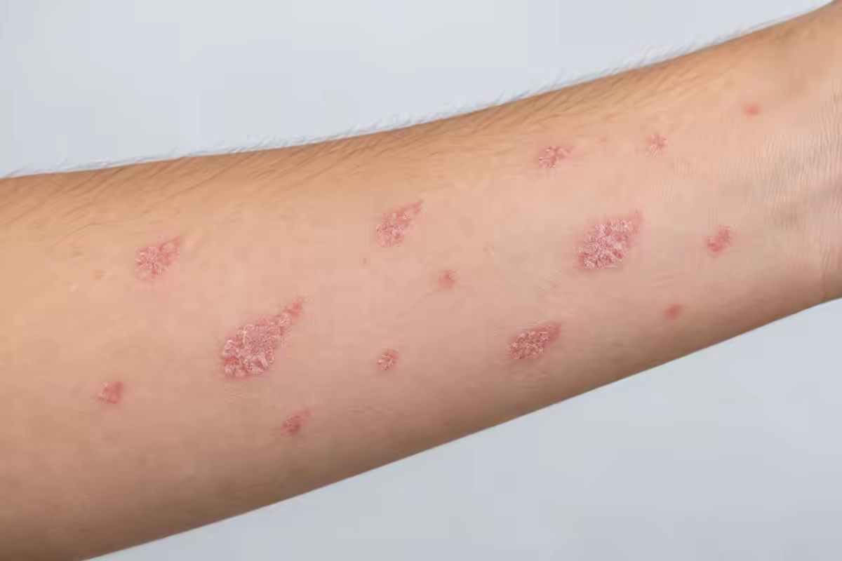 Các tổn thương nhỏ hình giọt nước trên da do vảy nến thể hạt cơm