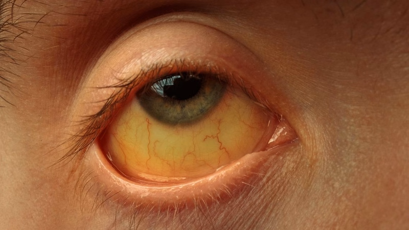 Minh họa tiến triển âm thầm của virus viêm gan B gây tổn thương tế bào gan