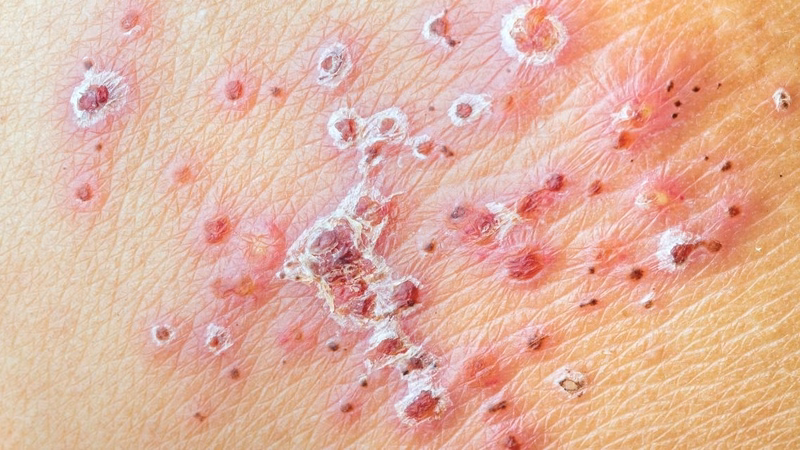 Hình ảnh mụn rộp sinh dục và tổn thương niêm mạc do nhiễm virus HSV