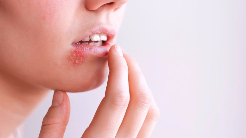 Hình ảnh minh họa tổn thương mụn nước nhỏ mọc thành cụm ở môi do virus Herpes simplex