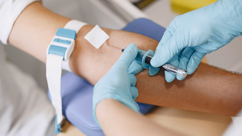 Bình chứa mẫu nước tiểu 24 giờ dùng trong quy trình xét nghiệm metanephrine tại cơ sở y tế
