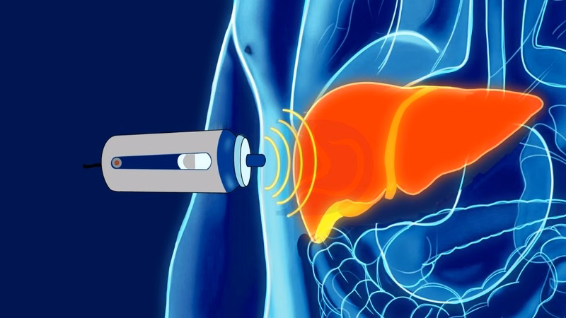 Kỹ thuật FibroScan đo độ đàn hồi mô gan giúp phát hiện xơ hóa gan F1
