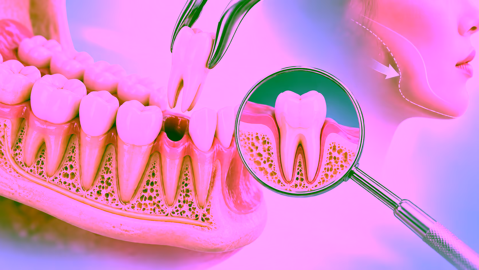 Minh hoạ nhổ răng số 4 và cấu trúc má